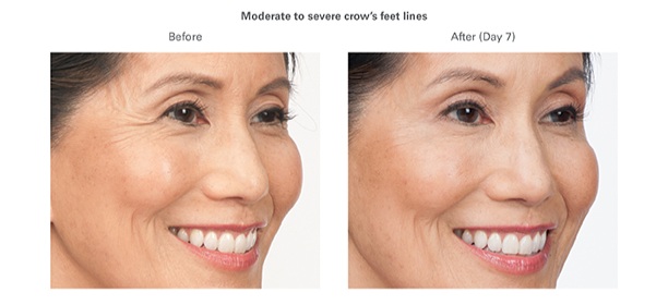 Botox in Kailua-Kona — Koru Medical Spa